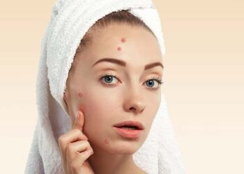 के तपाइको अनुहारमा दाग या डण्डीफोर आएर हैरान हुनुहुन्छ ? यी घरेलु उपचार अपनाउनुस्