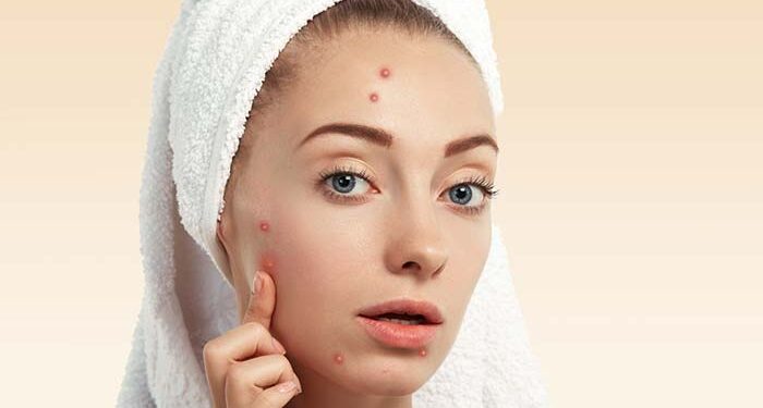 के तपाइको अनुहारमा दाग या डण्डीफोर आएर हैरान हुनुहुन्छ ? यी घरेलु उपचार अपनाउनुस्