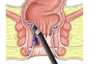 पायल्सको लेजर सर्जरी कति सुरक्षित छ ? अन्य उपचार के के हुन् ?