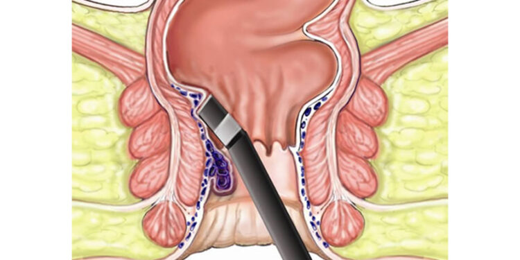 पायल्सको लेजर सर्जरी कति सुरक्षित छ ? अन्य उपचार के के हुन् ?