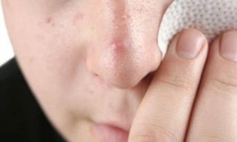 नाकको वरिपरि चिल्लो हुनु, स-साना कालो खिल बस्नु जस्ता समस्या छन ? यसरी छुटकारा पाउन सकिन्छ