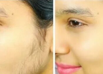 शरीरमा आउने अनावश्यक रौंलाई कसरी हटाउने ? यस्तो छ सजिलो तरिका