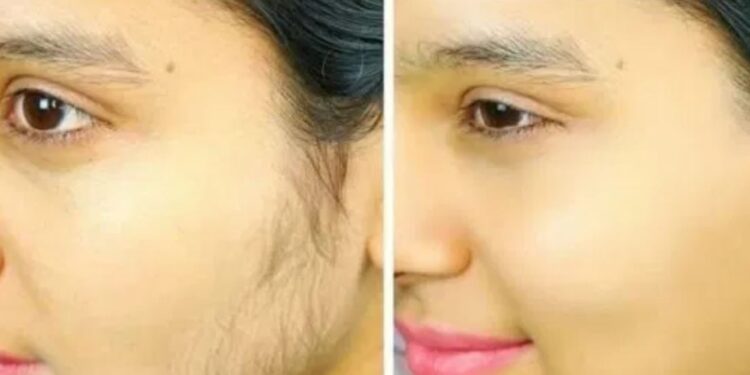 शरीरमा आउने अनावश्यक रौंलाई कसरी हटाउने ? यस्तो छ सजिलो तरिका