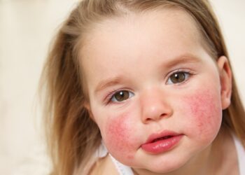 अभिभावक बनौं होसियार, बालबालिकालाई पनि हुनसक्छ एलर्जी