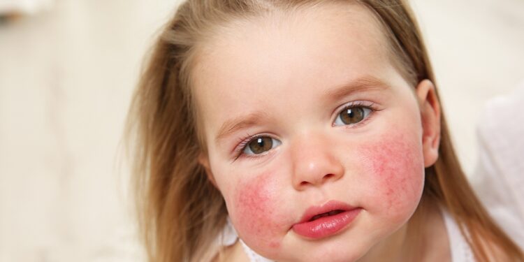 अभिभावक बनौं होसियार, बालबालिकालाई पनि हुनसक्छ एलर्जी