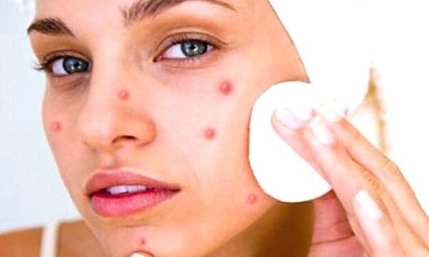 डन्डीफोर आउने समस्या कुन अवस्थामा बन्छ जटिल ?