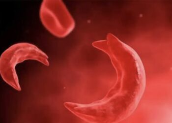 बाँकेमा बढ्दै सिकलसेल एनिमिया बिरामी