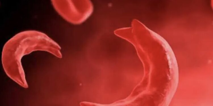 बाँकेमा बढ्दै सिकलसेल एनिमिया बिरामी