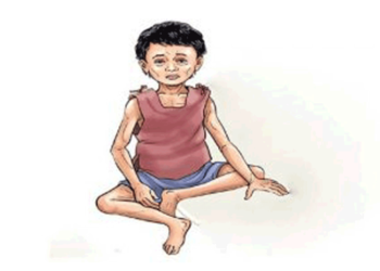 वीरगन्जमा कुपोषित बालबालिकाको सङ्ख्या बढ्दै