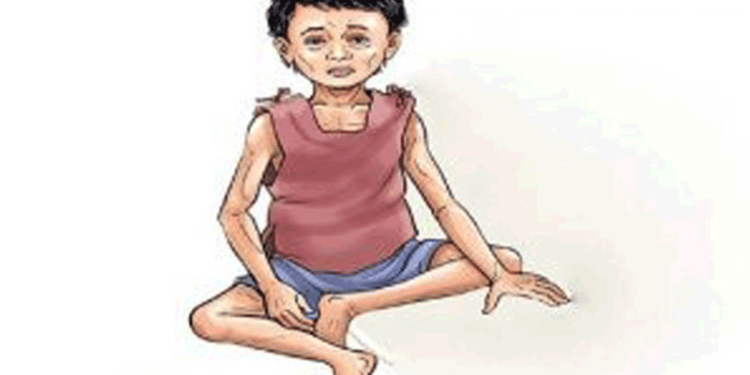 वीरगन्जमा कुपोषित बालबालिकाको सङ्ख्या बढ्दै